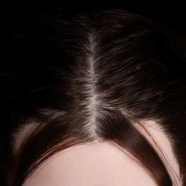 Capelli impiantati